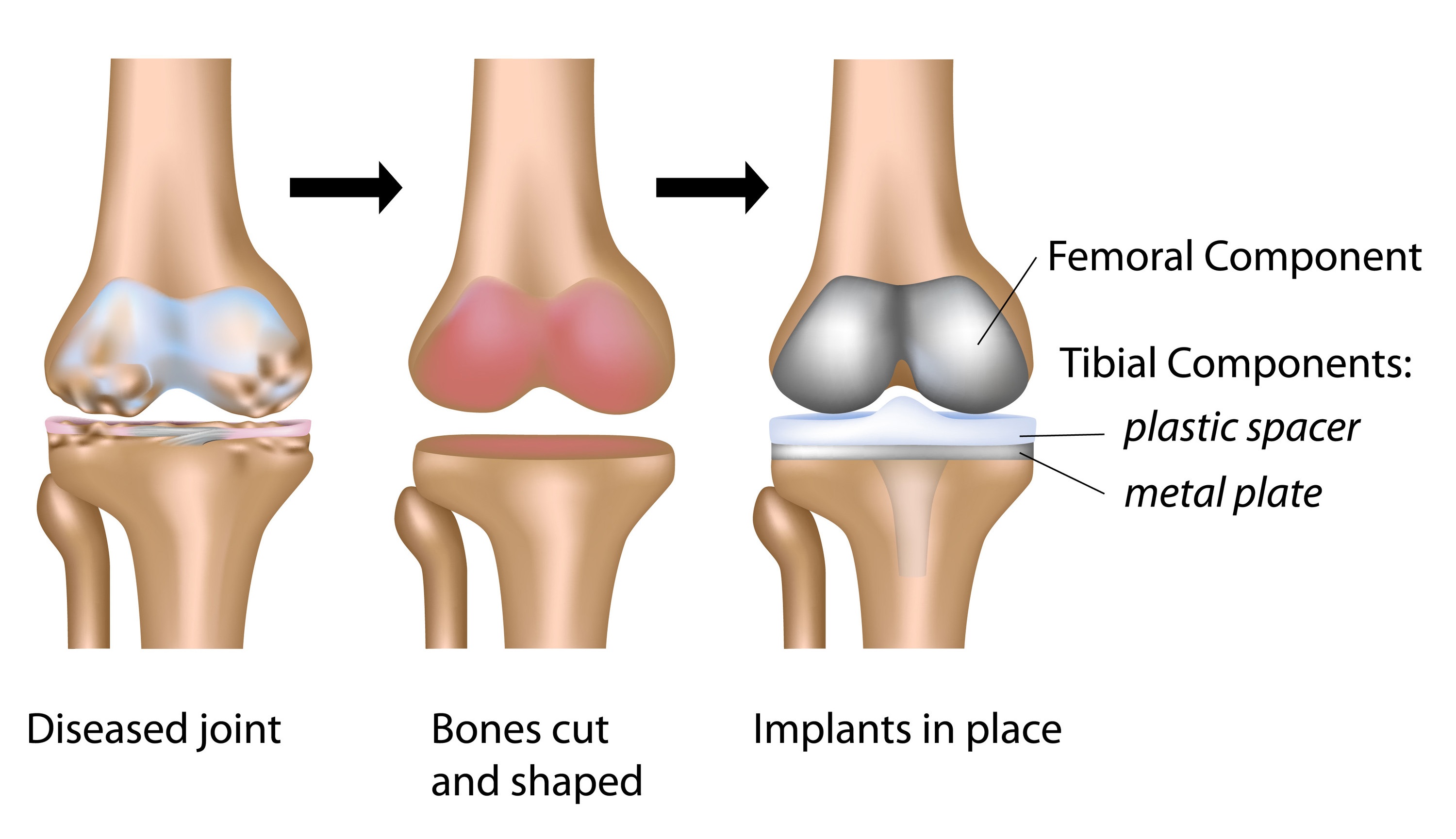 Physio-4 Therapies for Joint Replacement: Your Guide to Recovery and Mobility